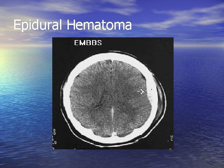 Epidural Hematoma 