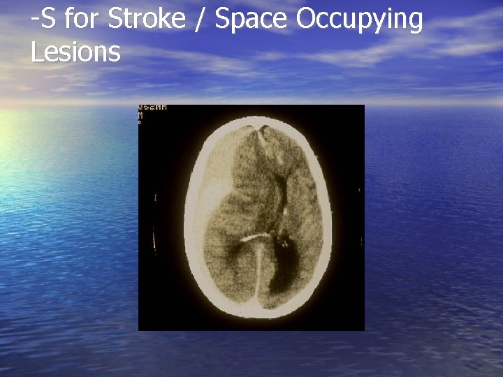 -S for Stroke / Space Occupying Lesions 