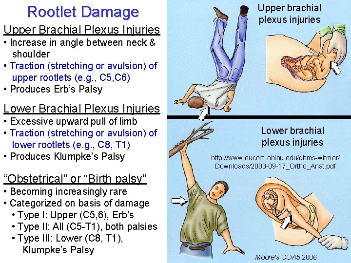 Rootlet Damage Upper Brachial Plexus Injuries Upper brachial plexus injuries • Increase in angle