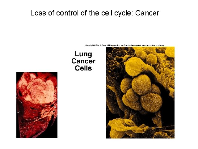 Loss of control of the cell cycle: Cancer 