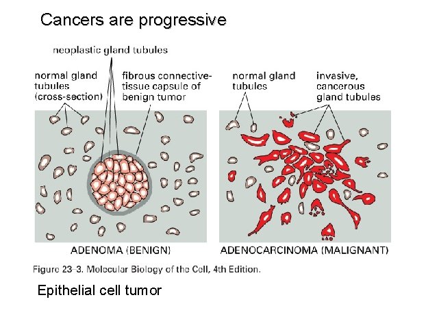 Cancers are progressive Epithelial cell tumor 