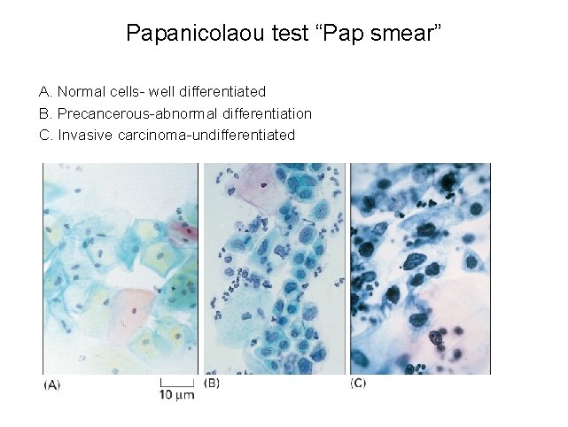 Papanicolaou test “Pap smear” A. Normal cells- well differentiated B. Precancerous-abnormal differentiation C. Invasive