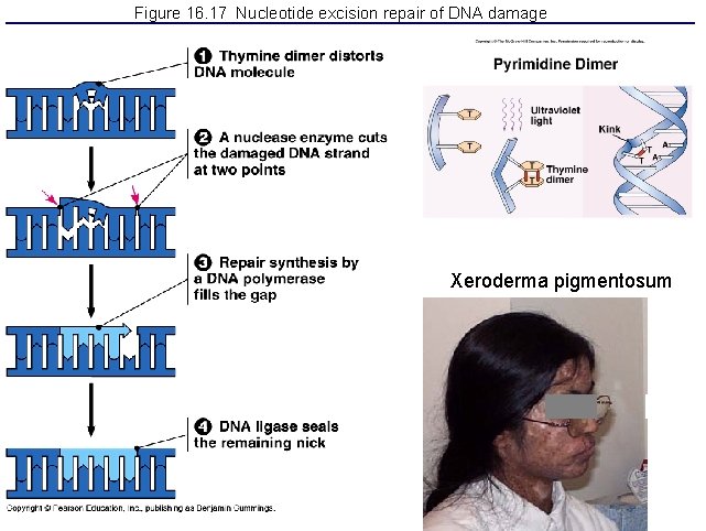 Figure 16. 17 Nucleotide excision repair of DNA damage Xeroderma pigmentosum 