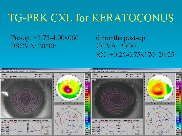 TG-PRK CXL for KERATOCONUS Pre-op: +1. 75 -4. 00 x 060 BSCVA: 20/30 - TG-PRK CXL for KERATOCONUS Pre-op: +1. 75 -4. 00 x 060 BSCVA: 20/30 -