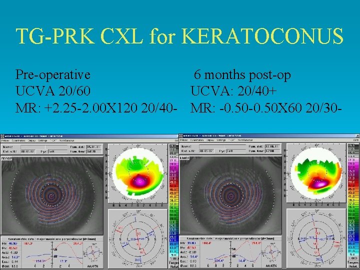 TG-PRK CXL for KERATOCONUS Pre-operative 6 months post-op UCVA 20/60 UCVA: 20/40+ MR: +2. TG-PRK CXL for KERATOCONUS Pre-operative 6 months post-op UCVA 20/60 UCVA: 20/40+ MR: +2.