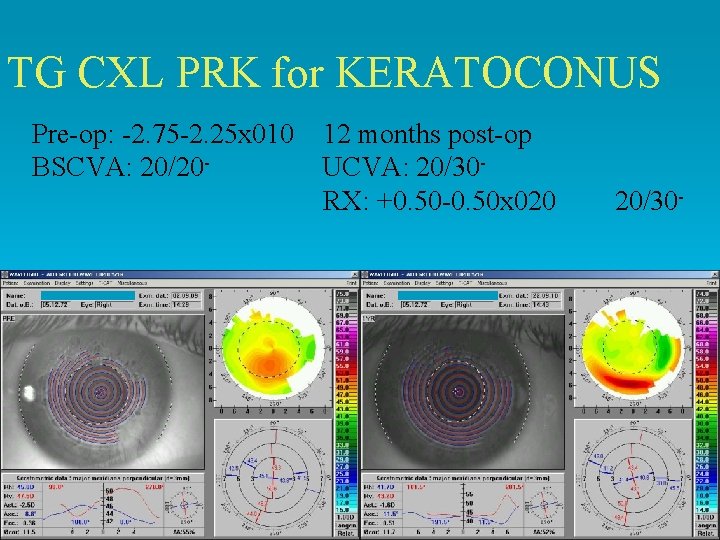 TG CXL PRK for KERATOCONUS Pre-op: -2. 75 -2. 25 x 010 BSCVA: 20/20 TG CXL PRK for KERATOCONUS Pre-op: -2. 75 -2. 25 x 010 BSCVA: 20/20