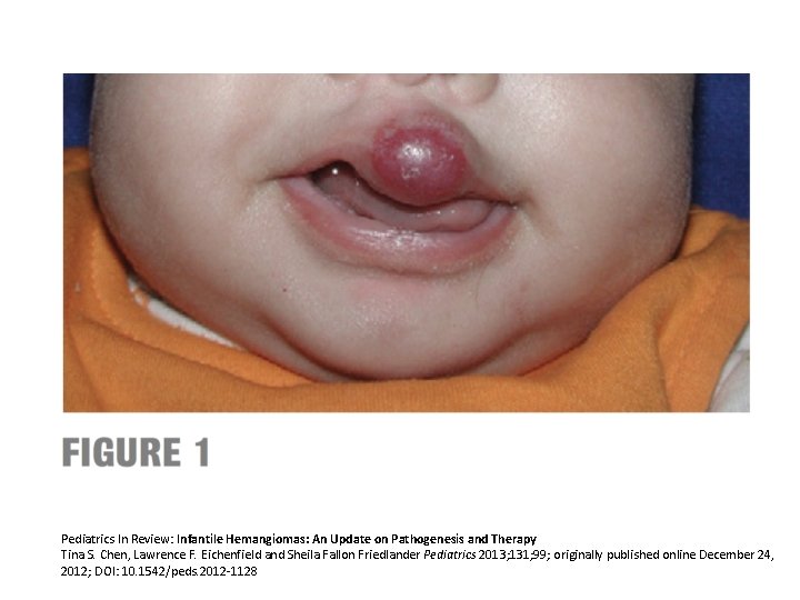 Pediatrics In Review: Infantile Hemangiomas: An Update on Pathogenesis and Therapy Tina S. Chen,