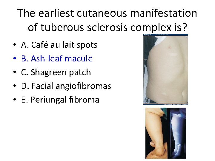 The earliest cutaneous manifestation of tuberous sclerosis complex is? • • • A. Café