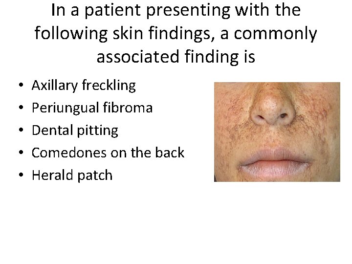 In a patient presenting with the following skin findings, a commonly associated finding is