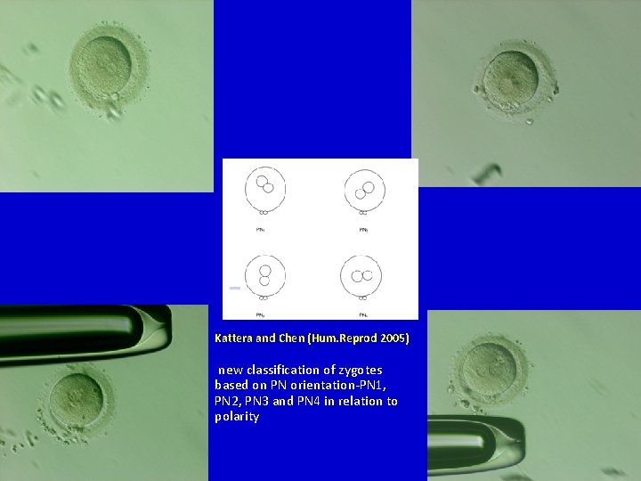 Kattera and Chen (Hum. Reprod 2005) new classification of zygotes based on PN Kattera and Chen (Hum. Reprod 2005) new classification of zygotes based on PN
