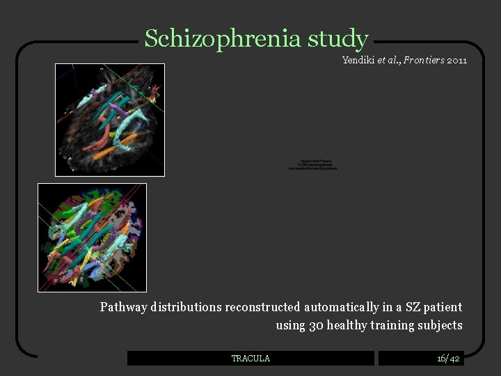 Schizophrenia study Yendiki et al. , Frontiers 2011 Pathway distributions reconstructed automatically in a
