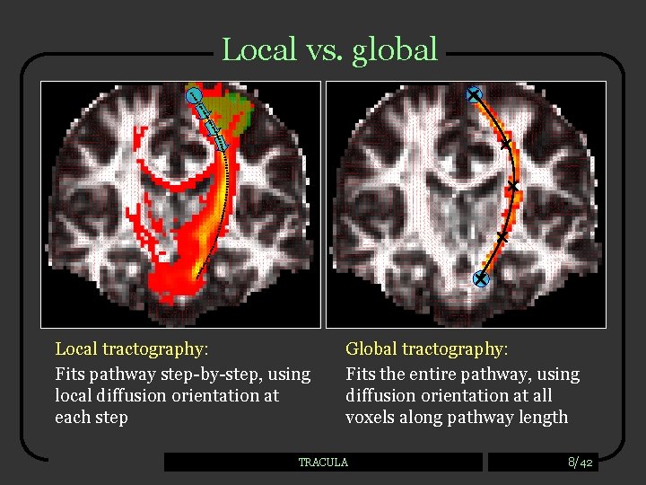Local vs. global Local tractography: Fits pathway step-by-step, using local diffusion orientation at each
