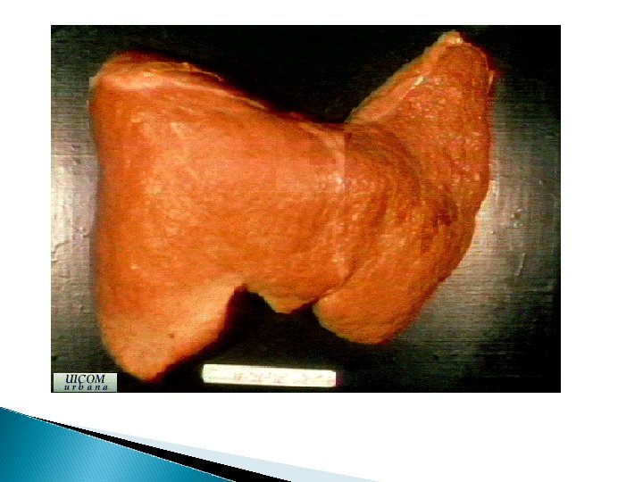 cirrhotic liver 