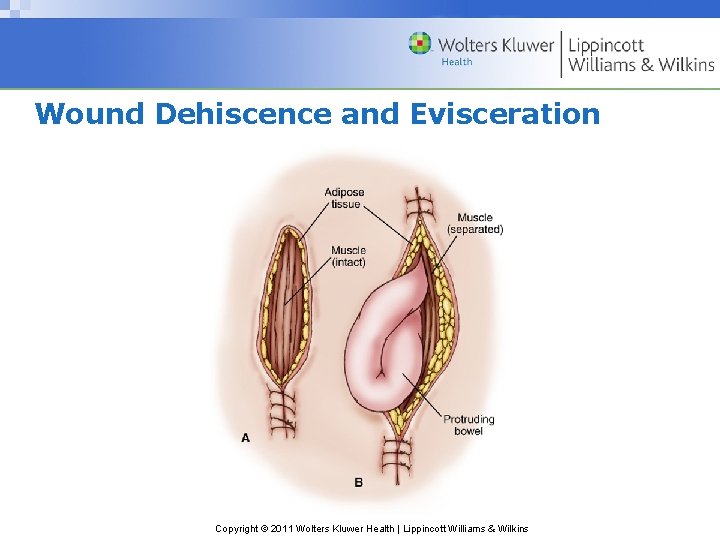 Wound Dehiscence and Evisceration Copyright © 2011 Wolters Kluwer Health | Lippincott Williams & Wound Dehiscence and Evisceration Copyright © 2011 Wolters Kluwer Health | Lippincott Williams &