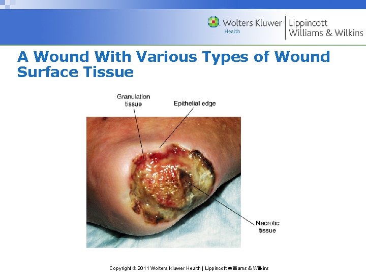 A Wound With Various Types of Wound Surface Tissue Copyright © 2011 Wolters Kluwer A Wound With Various Types of Wound Surface Tissue Copyright © 2011 Wolters Kluwer