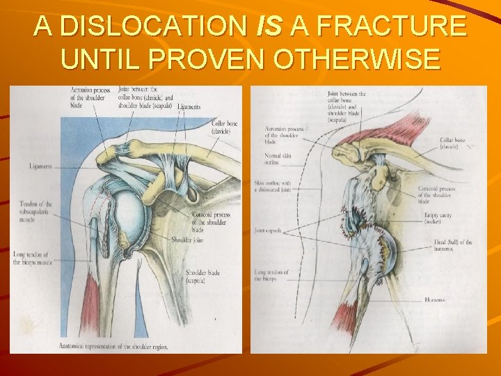 A DISLOCATION IS A FRACTURE UNTIL PROVEN OTHERWISE 