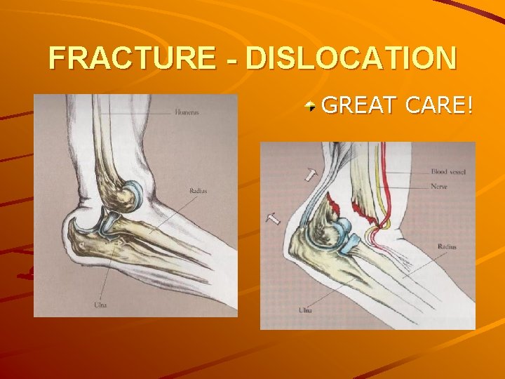 FRACTURE - DISLOCATION GREAT CARE! 