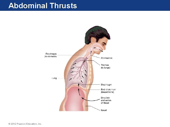 Abdominal Thrusts © 2012 Pearson Education, Inc. Abdominal Thrusts © 2012 Pearson Education, Inc.