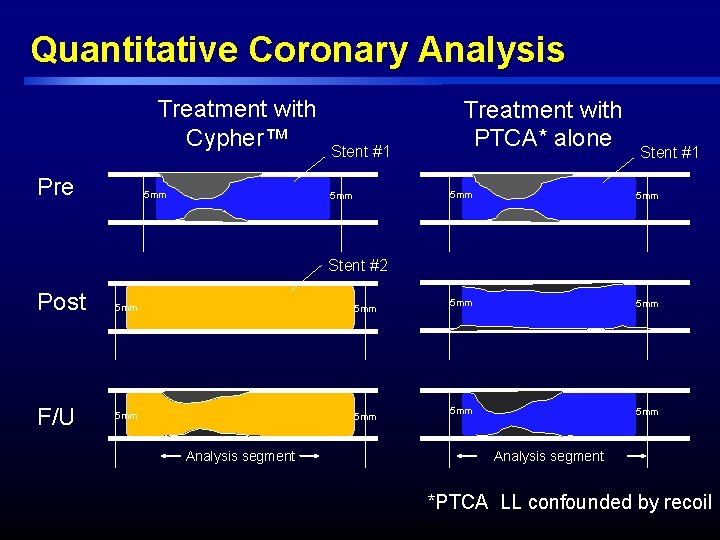 Quantitative Coronary Analysis Treatment with Cypher™ Pre 5 mm Stent #1 5 mm Treatment Quantitative Coronary Analysis Treatment with Cypher™ Pre 5 mm Stent #1 5 mm Treatment