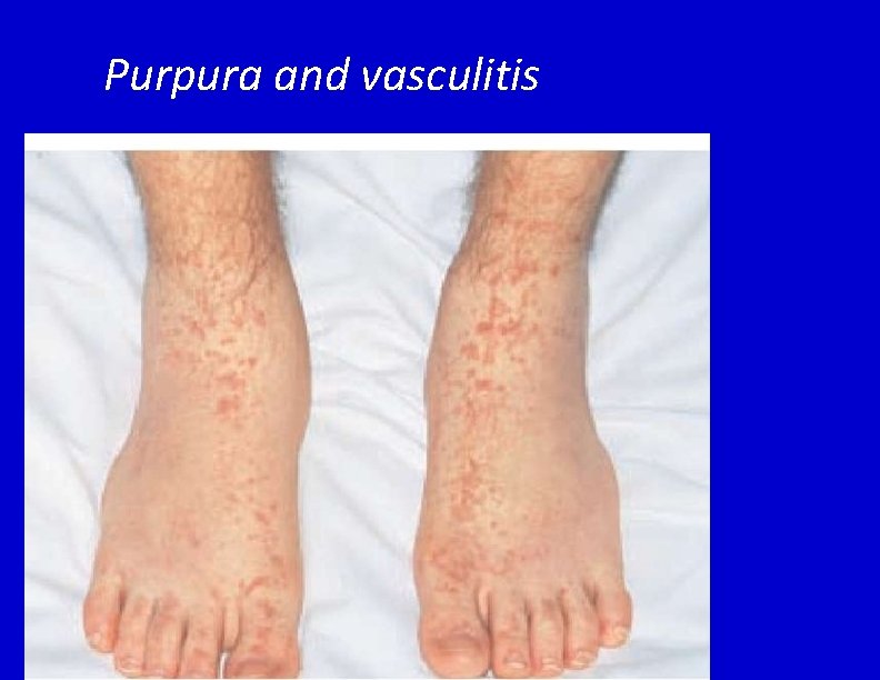 Purpura and vasculitis 