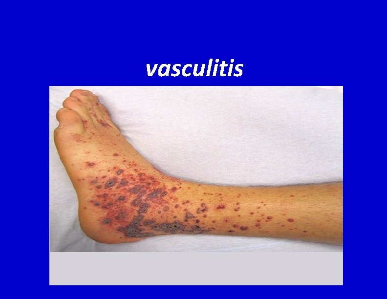 vasculitis 