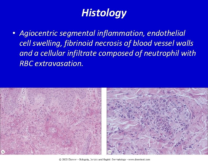 Histology • Agiocentric segmental inflammation, endothelial cell swelling, fibrinoid necrosis of blood vessel walls