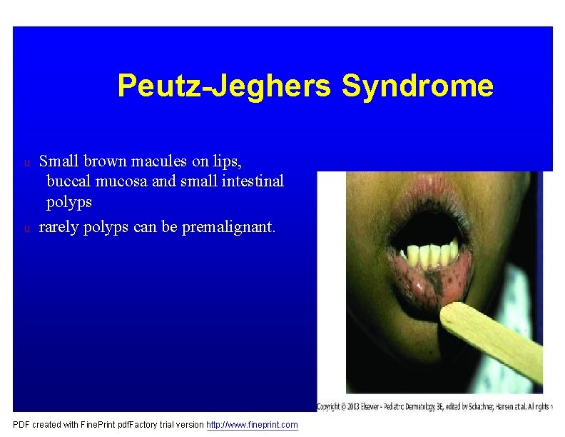 Peutz-Jeghers Syndrome u u Small brown macules on lips, buccal mucosa and small intestinal