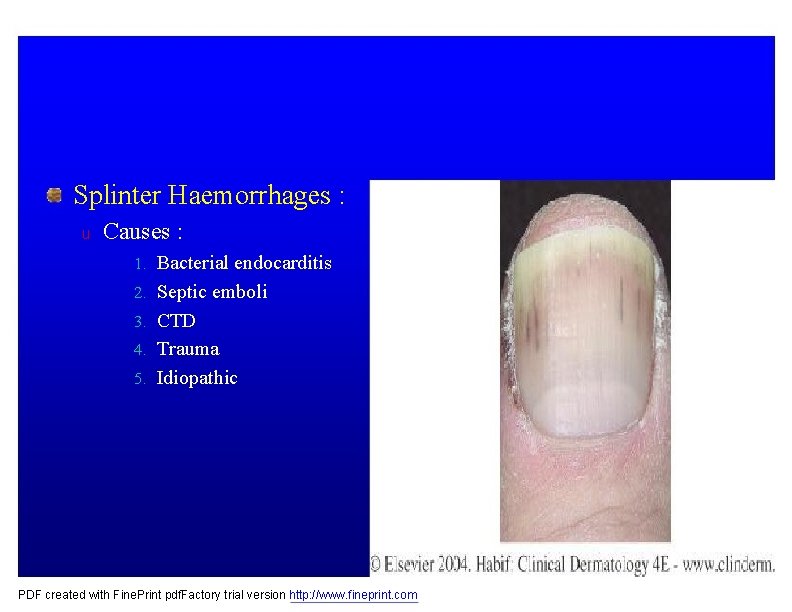 Splinter Haemorrhages : u Causes : 1. Bacterial endocarditis 2. Septic emboli 3. CTD