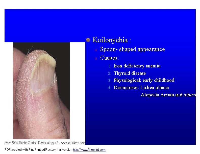 Koilonychia : u u Spoon- shaped appearance Causes: 1. Iron deficiency anemia 2. Thyroid