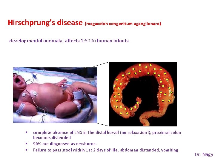 Hirschprung’s disease (megacolon congenitum aganglionare) -developmental anomaly; affects 1: 5000 human infants. • •