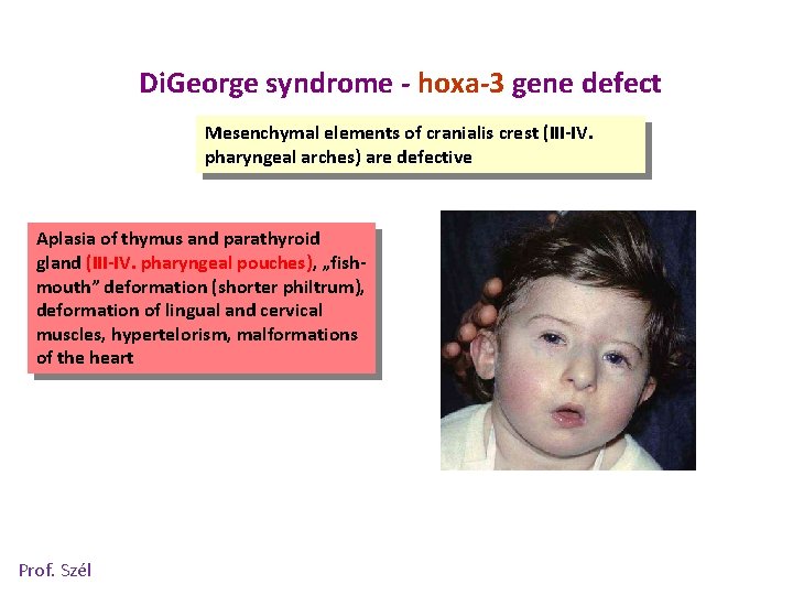 Di. George syndrome - hoxa-3 gene defect Mesenchymal elements of cranialis crest (III-IV. pharyngeal