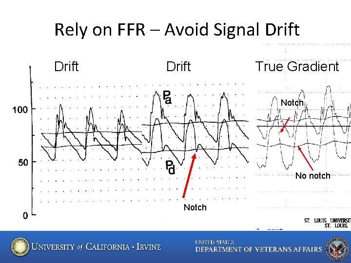 Rely on FFR – Avoid Signal Drift True Gradient Notch No notch Notch 