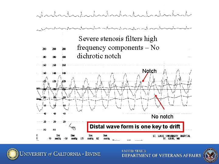 Severe stenosis filters high frequency components – No dichrotic notch No notch Distal wave