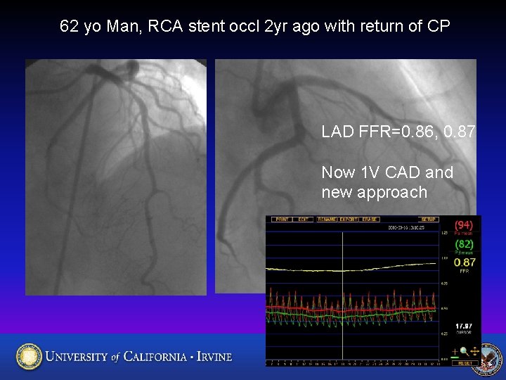 62 yo Man, RCA stent occl 2 yr ago with return of CP LAD