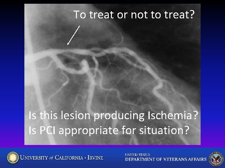 To treat or not to treat? Is this lesion producing Ischemia? Is PCI appropriate