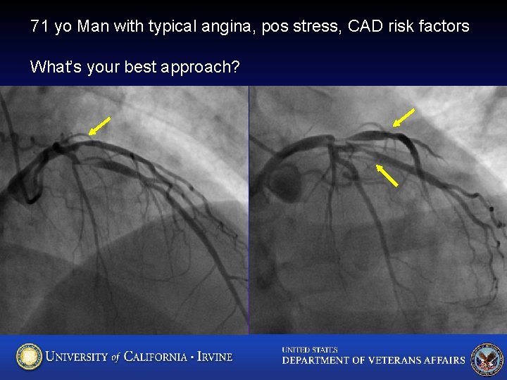 71 yo Man with typical angina, pos stress, CAD risk factors What’s your best