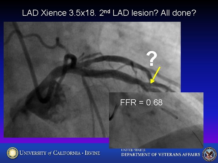 LAD Xience 3. 5 x 18. 2 nd LAD lesion? All done? ? FFR