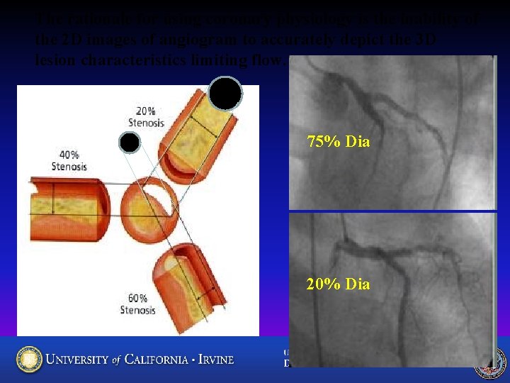 The rationale for using coronary physiology is the inability of the 2 D images