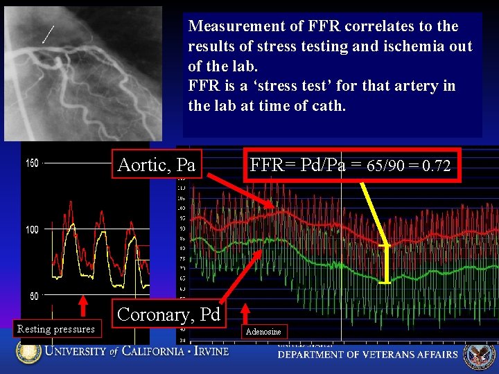 Measurement of FFR correlates to the results of stress testing and ischemia out of