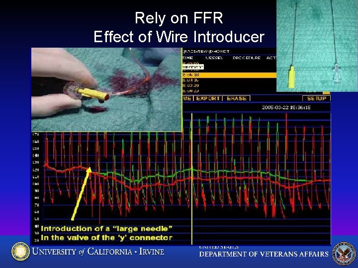Rely on FFR Effect of Wire Introducer 