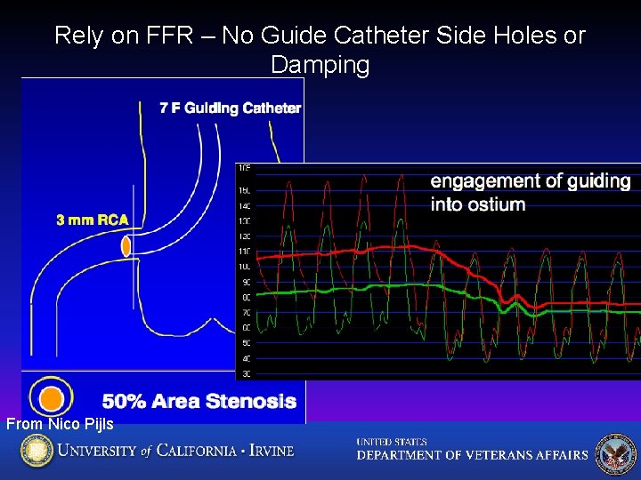 Rely on FFR – No Guide Catheter Side Holes or Damping From Nico Pijls