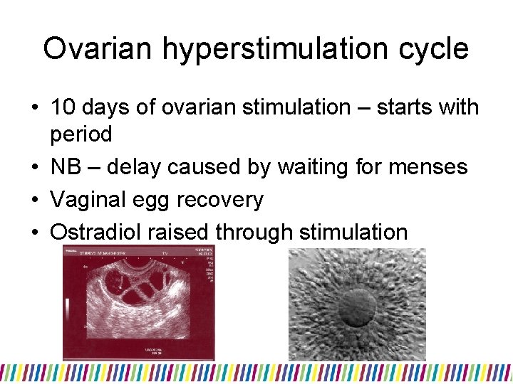 Ovarian hyperstimulation cycle • 10 days of ovarian stimulation – starts with period •