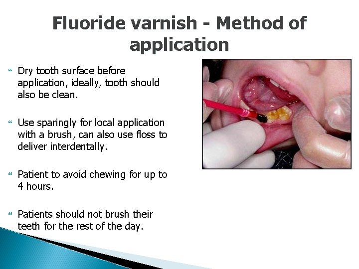 Fluoride varnish - Method of application Dry tooth surface before application, ideally, tooth should
