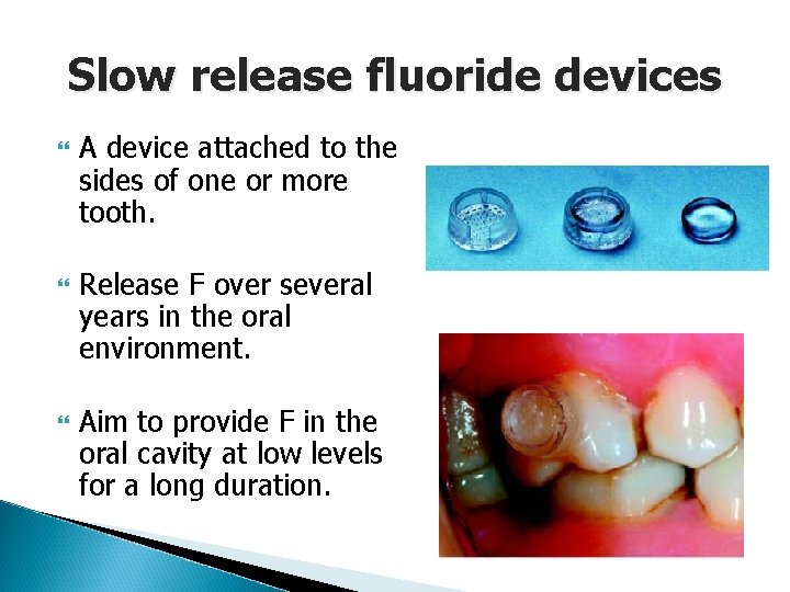 Slow release fluoride devices A device attached to the sides of one or more