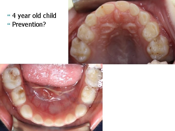  4 year old child Prevention? 