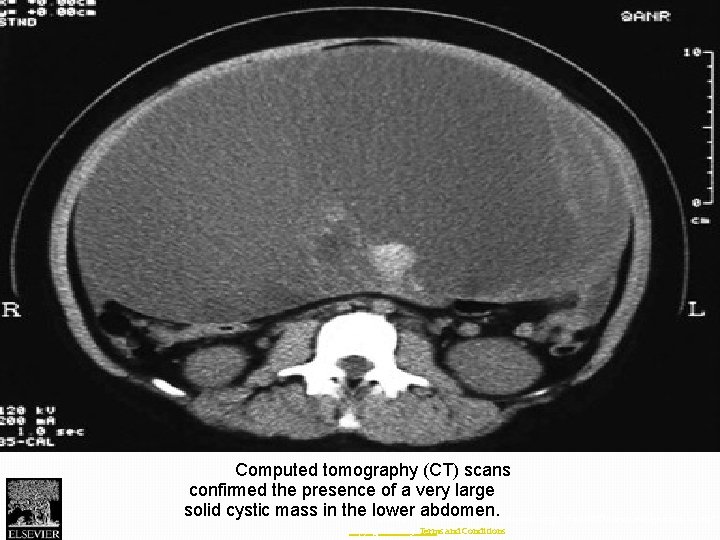 Fig. 1 Computed tomography (CT) scans confirmed the presence of a very large solid