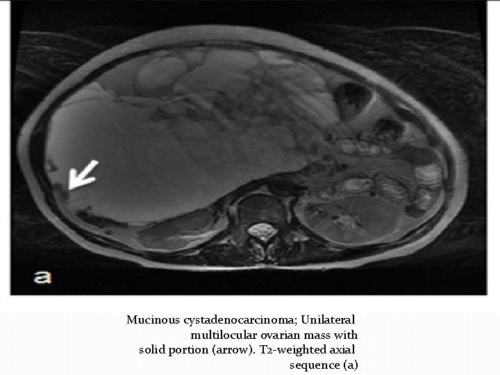 Mucinous cystadenocarcinoma; Unilateral multilocular ovarian mass with solid portion (arrow). T 2 -weighted axial