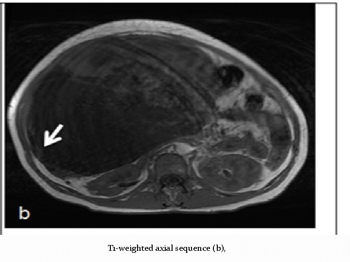 T 1 -weighted axial sequence (b), 