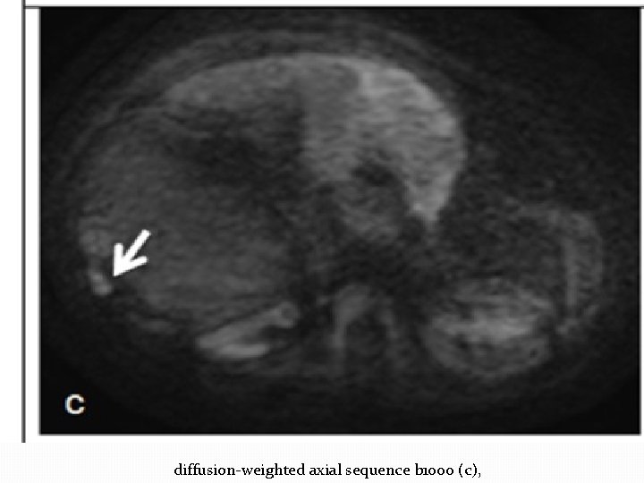 diffusion-weighted axial sequence b 1000 (c), 