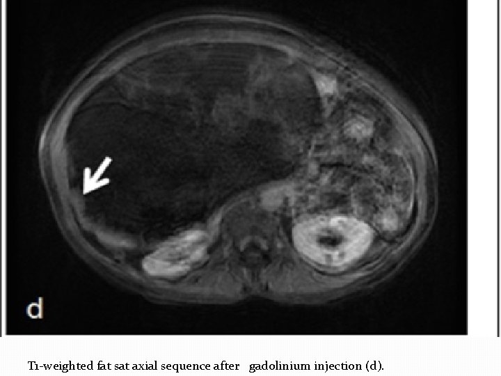 T 1 -weighted fat sat axial sequence after gadolinium injection (d). 